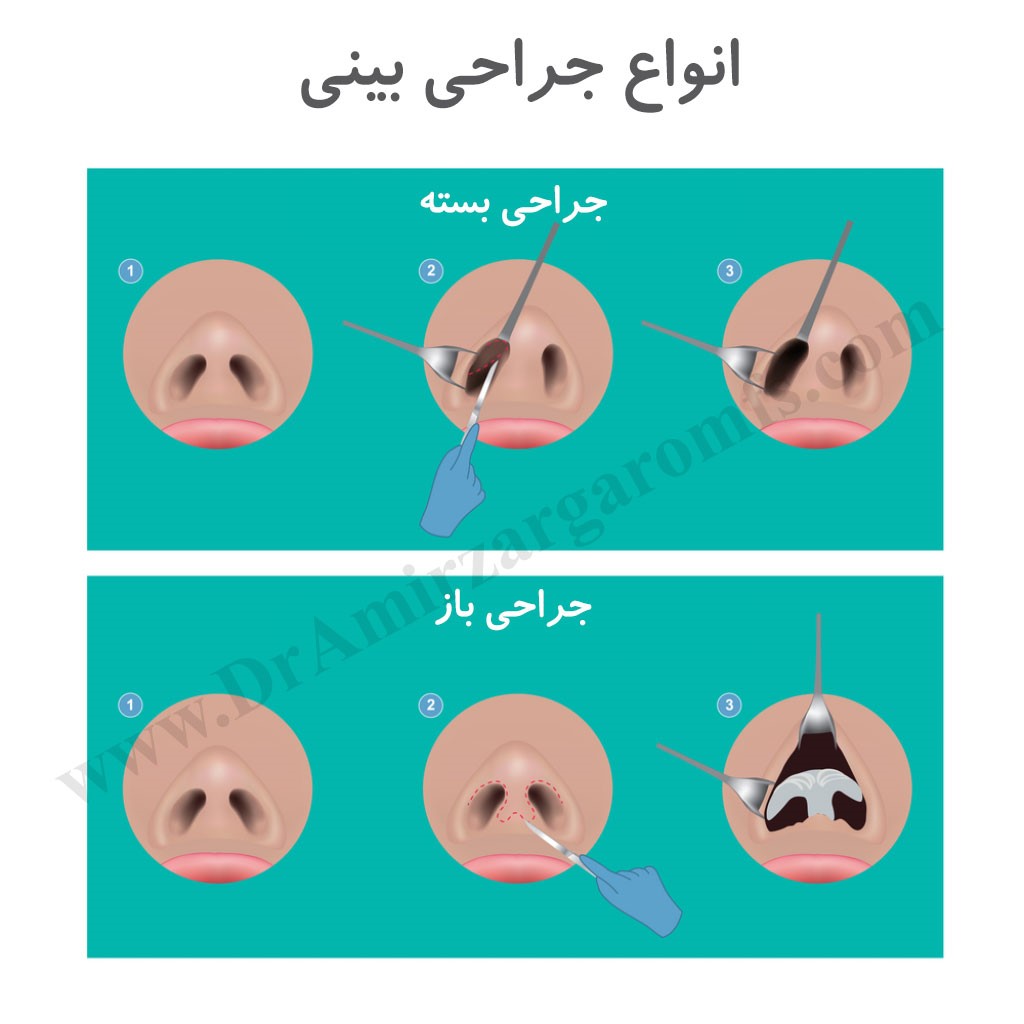 انواع جراحی بینی