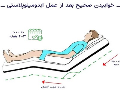 خوابیدن صحیح بعد از ابدومینوپلاستی