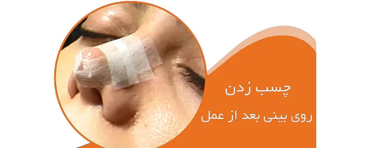 تاثیر چسب زدن بعد از جراحی رینوپلاستی